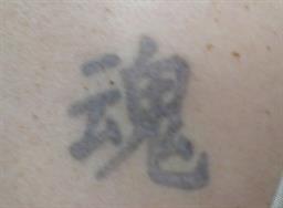 Image of tattoo after laser tattoo removal