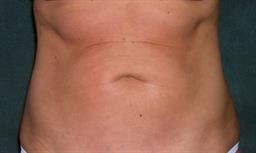 Front of abdomen after surgery