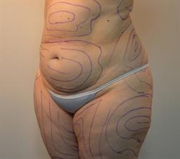 left oblique view of abdomen before liposuction