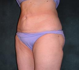 left oblique view of abdomen after liposuction