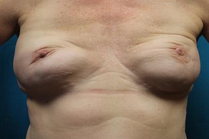 Before with flexing