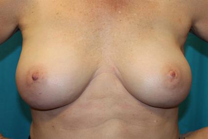 After 6 wks with no flexing