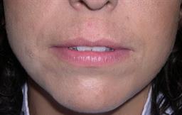 Front of lips before Restylane