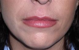 Front of lips 2 weeks after Restylane