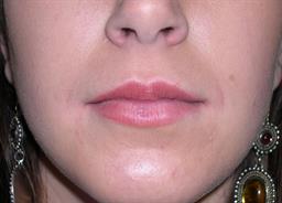 Front of lips before Restylane