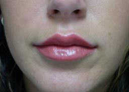 Front of lips 1 week after Restylane