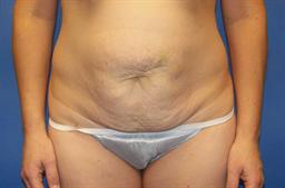 Front of abdomen before surgery