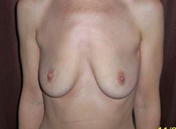 Front of breasts before surgery