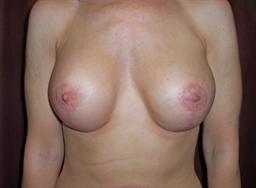 Front of breasts after surgery