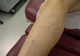 Leg before sclerotherapy