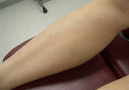 Leg after sclerotherapy