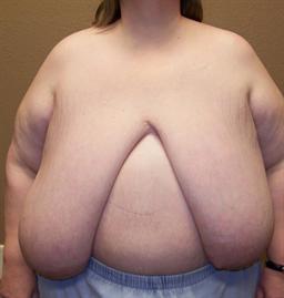 Front of breasts before surgery