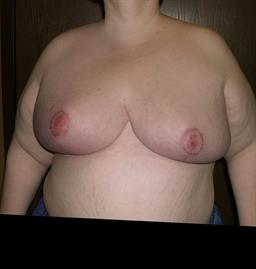 Front of breasts after surgery