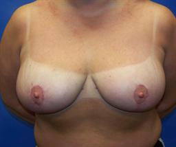 Front of breasts after surgery