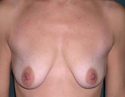 Front of breasts before surgery