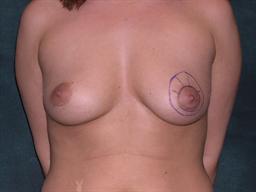 Front of breasts before surgery