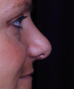 Right view of nose after rhinoplasty