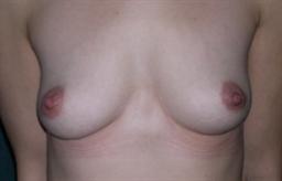 Front of breasts before surgery