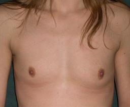Front of breasts before surgery