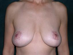 Front of breasts after surgery