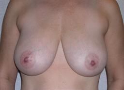 Front of breasts before surgery