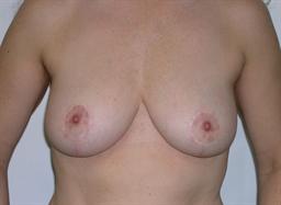 Front of breasts after surgery