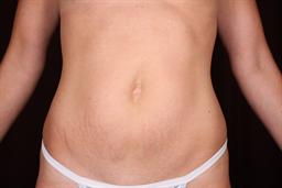 Front of abdomen before surgery