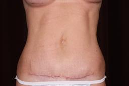 Front of abdomen after surgery