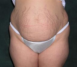 Front of abdomen before surgery