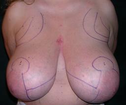 Front of breasts before surgery