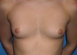 Front of breasts before surgery