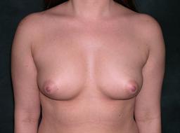 Front of breasts before surgery