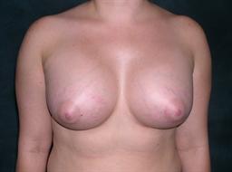 Front of breasts after surgery