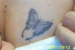 Front view before laser tattoo removal