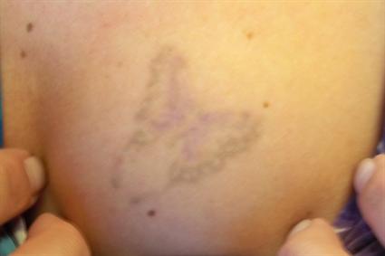 After 3 Treatments