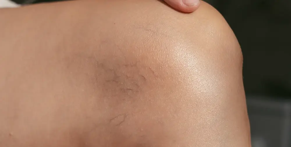 spider veins