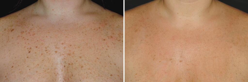 BBL Before and After