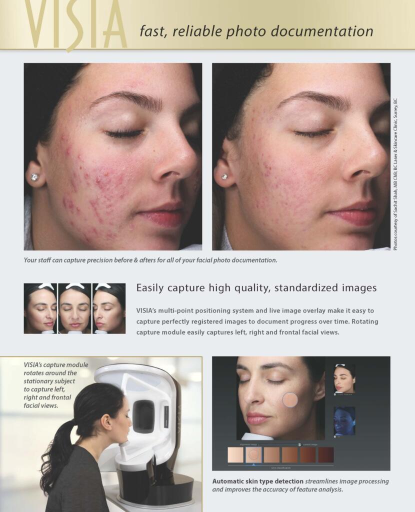 Visia complexion analysis image