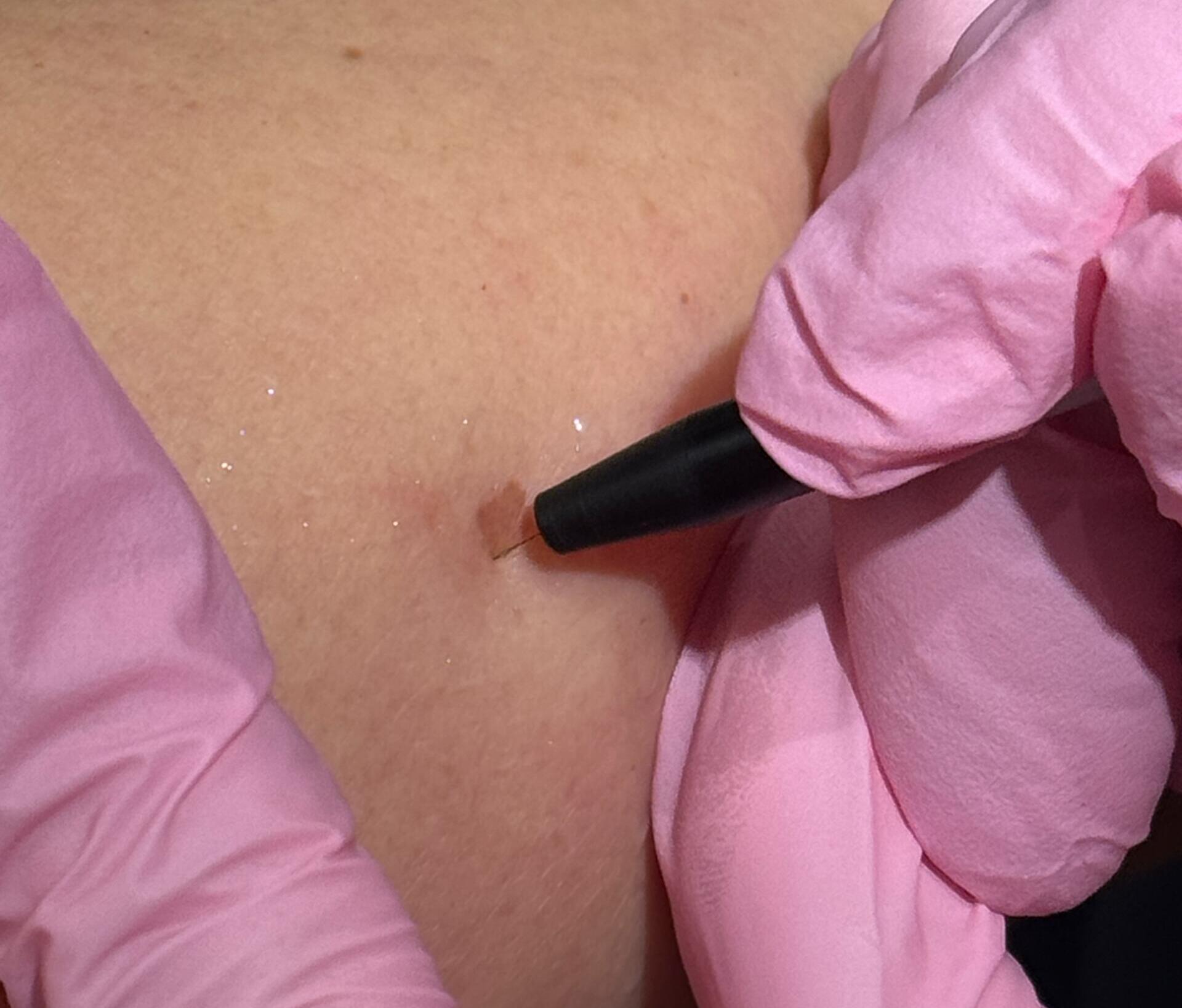 Thermoclear for brown spot on back of arm