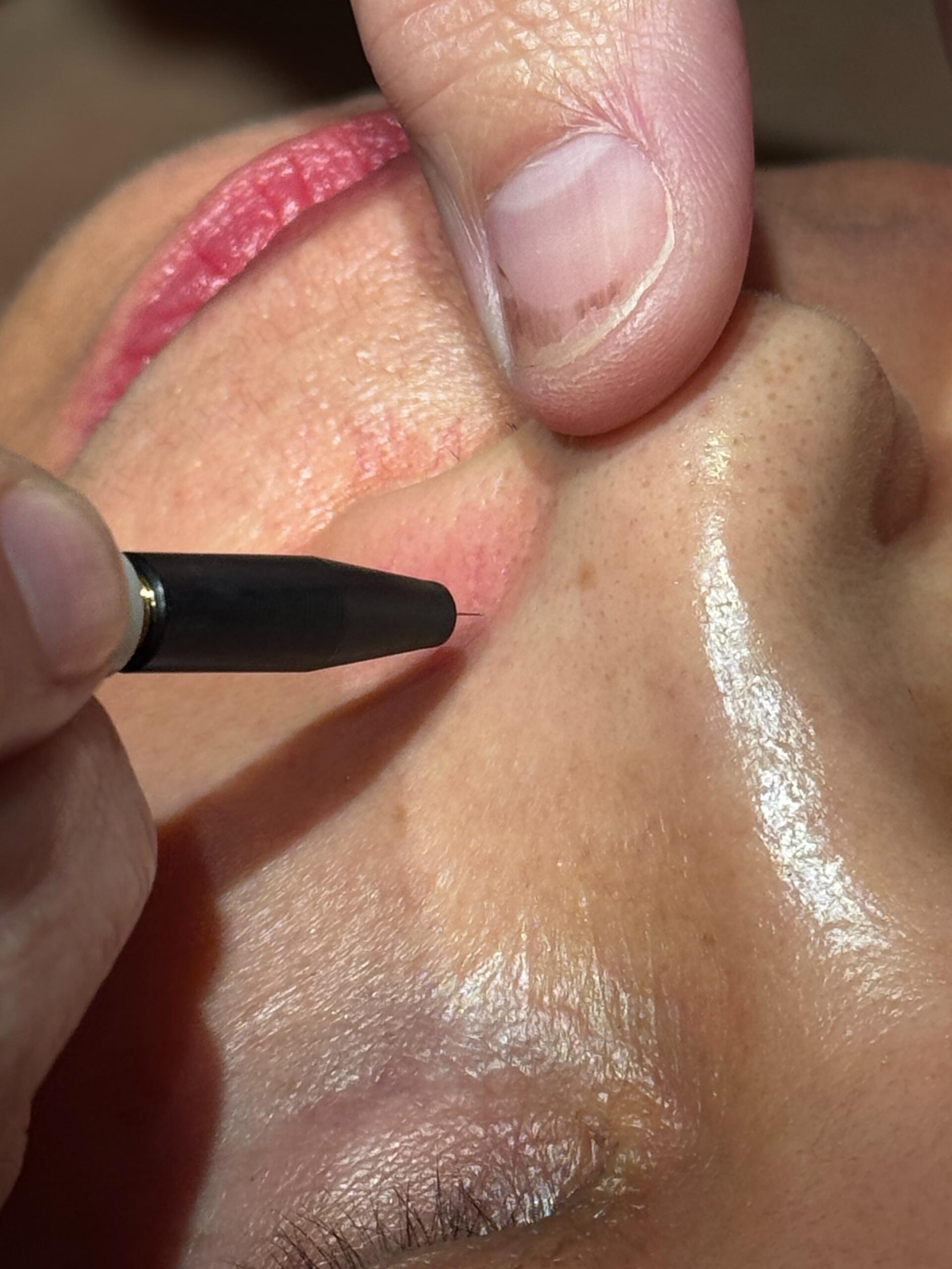 Thermoclear for spider veins on nose