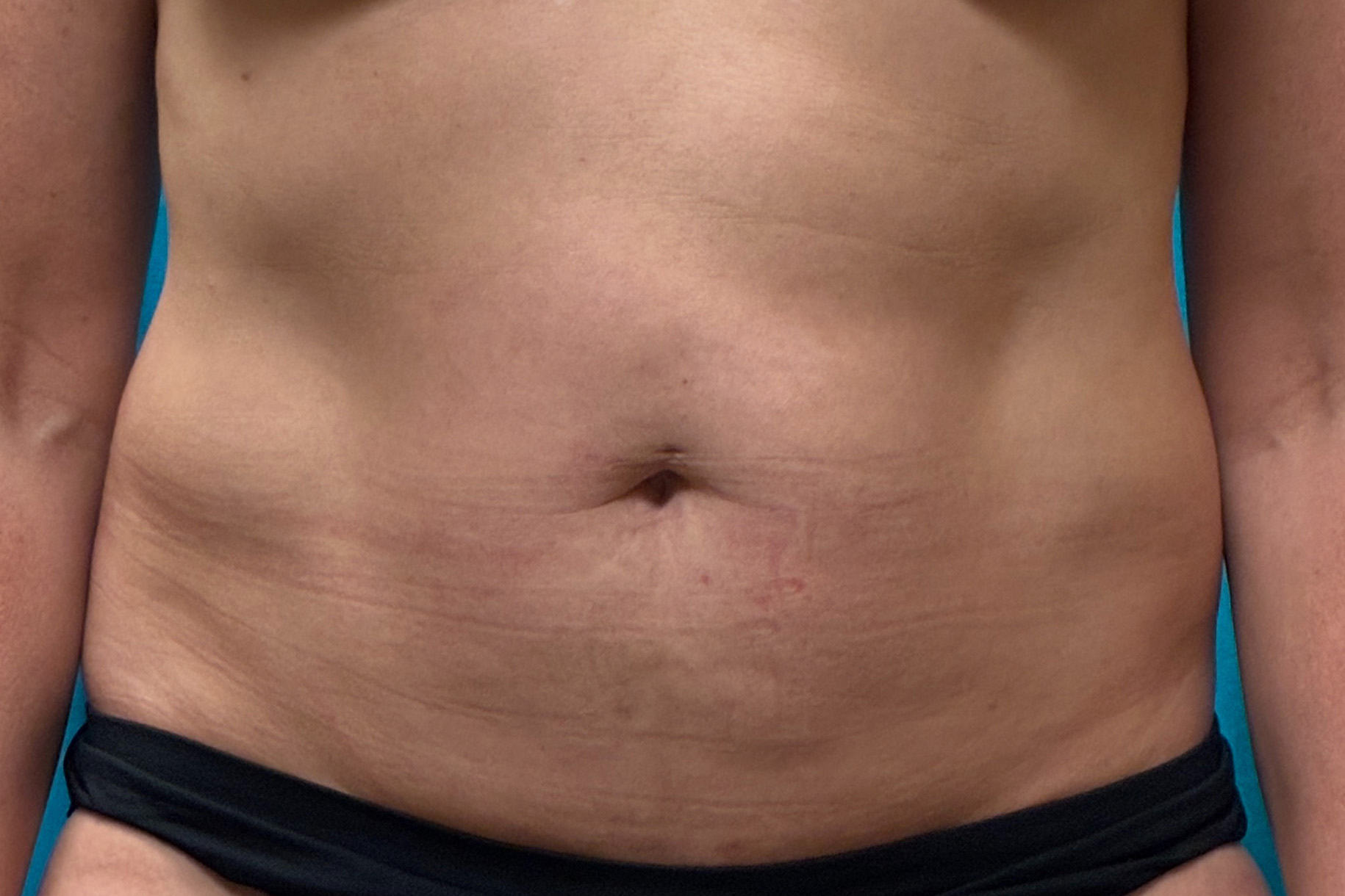 Abdomen Front after