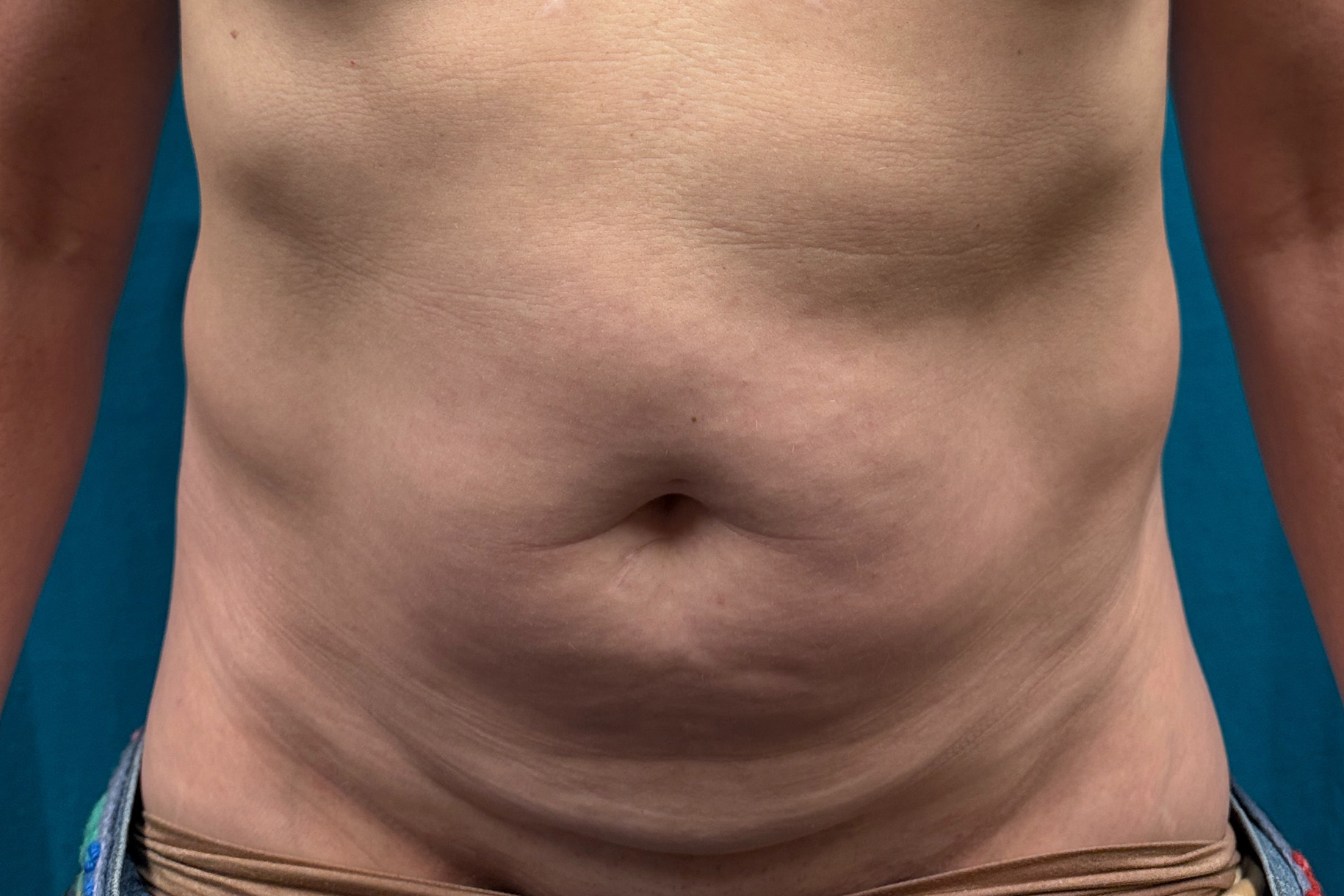 Abdomen Front before