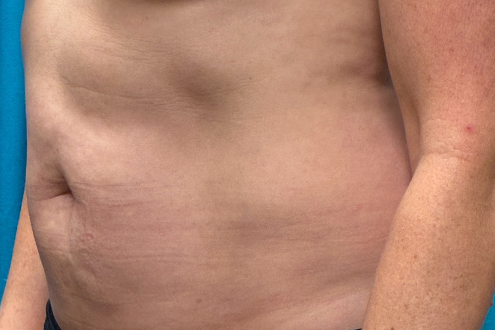 Abdomen Oblique after