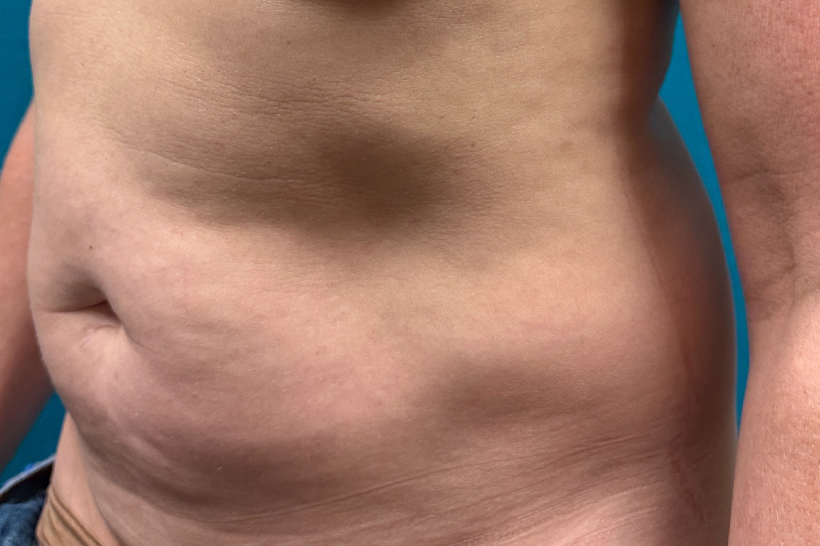 Abdomen Oblique before