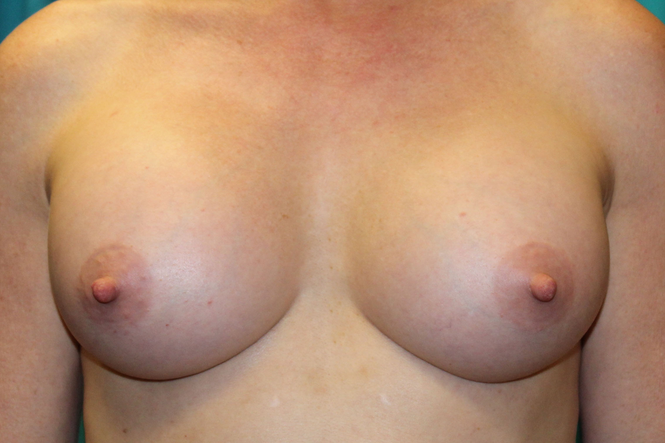 Breasts Front after
