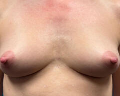 Breasts Front before