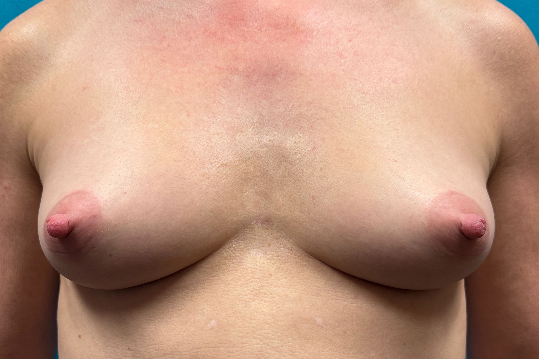 Breasts Front before