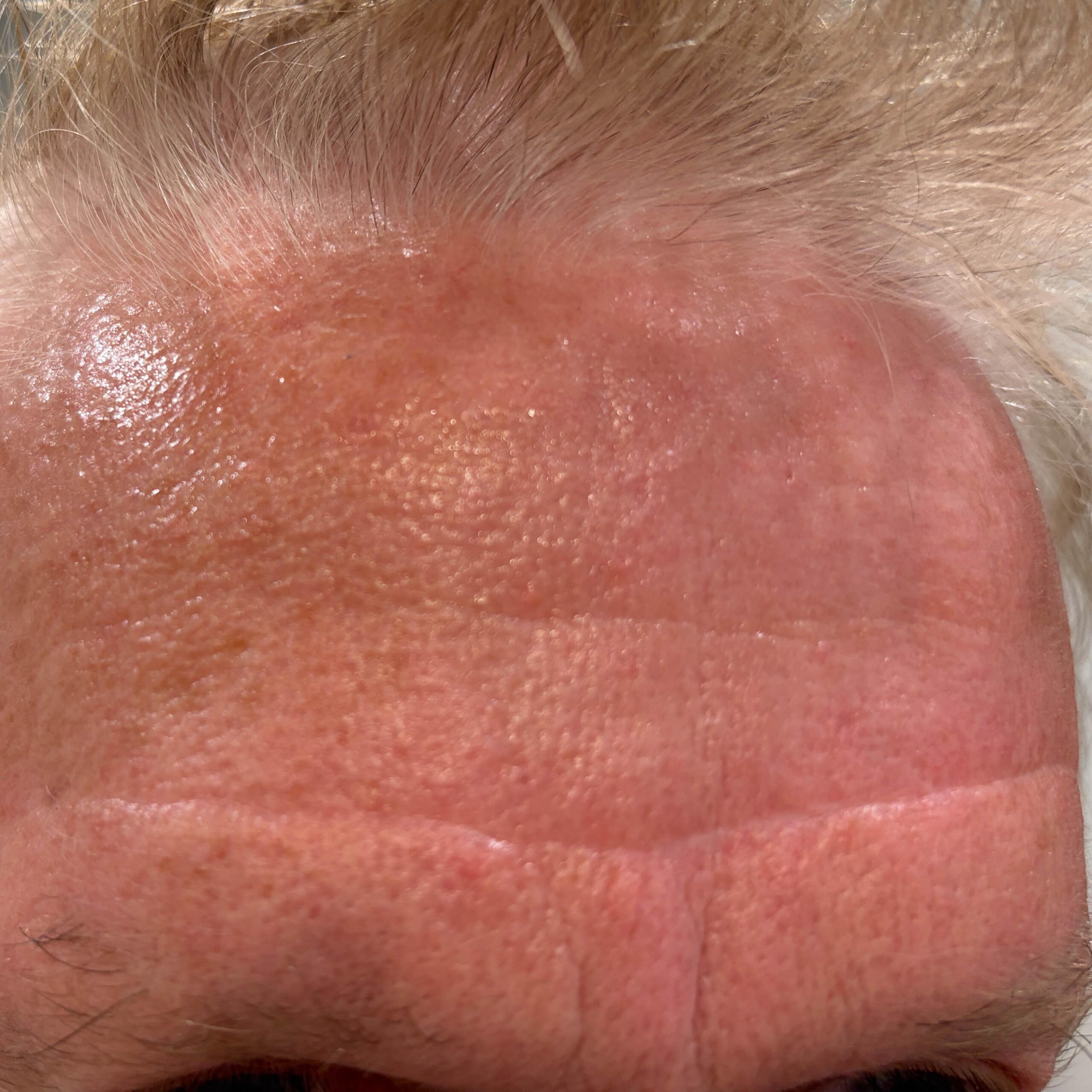 Forehead after case 413