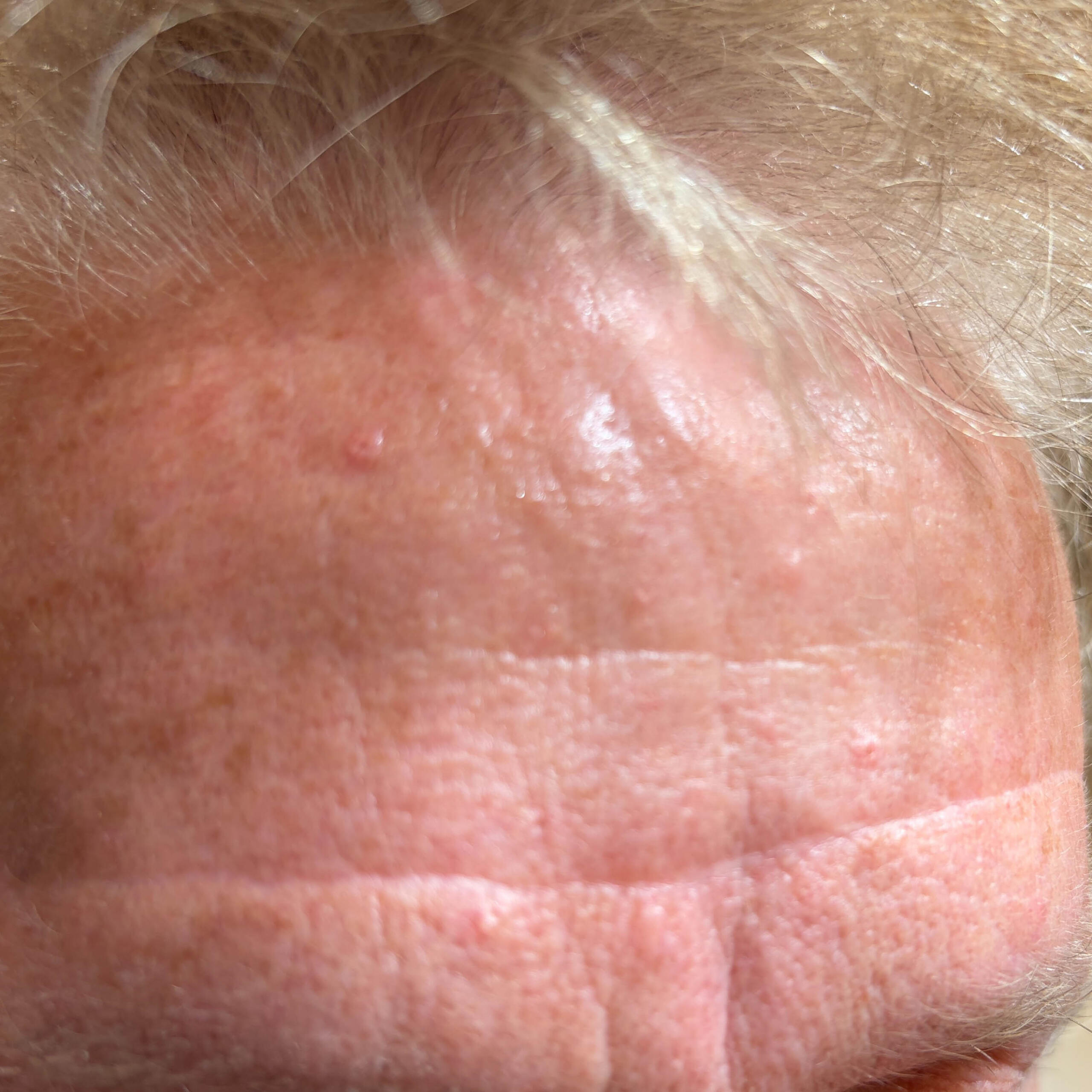 Forehead before case 413