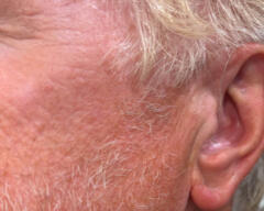 Left Cheek after case 414